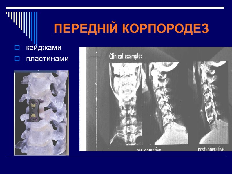 ПЕРЕДНІЙ КОРПОРОДЕЗ кейджами пластинами